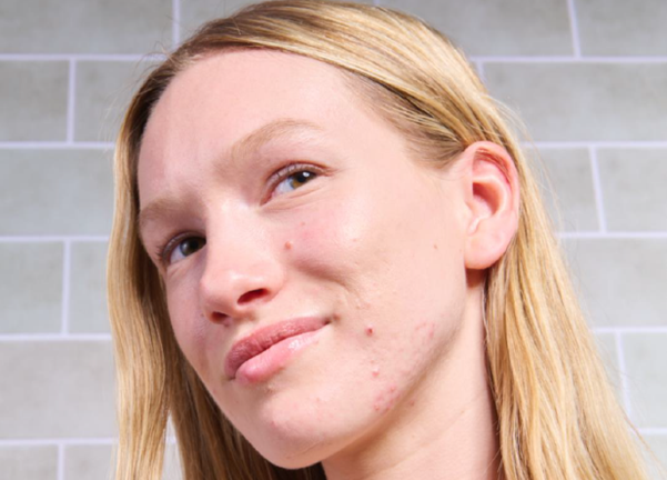 Tudo o que precisas de saber sobre a acne